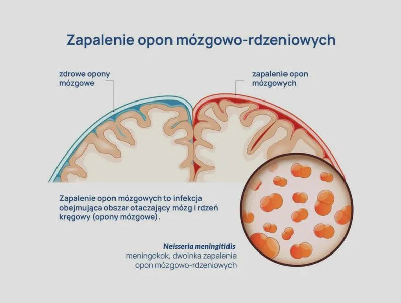 Diagnostyka zapalenia opon mózgowych