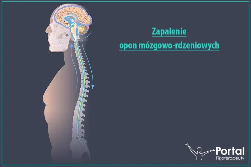 Objawy zapalenia opon