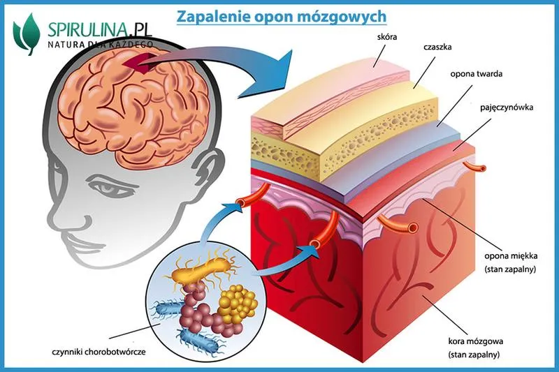 Objawy zapalenia opon mózgowych
